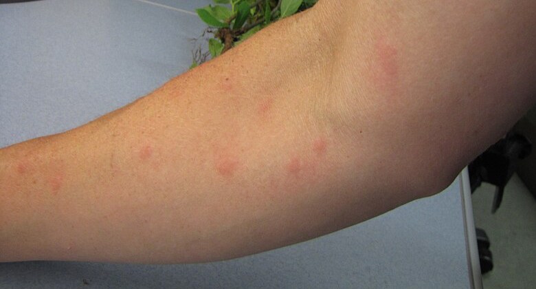 腕に赤い膨らみ（膨疹）が多発している蚊による虫刺されの例