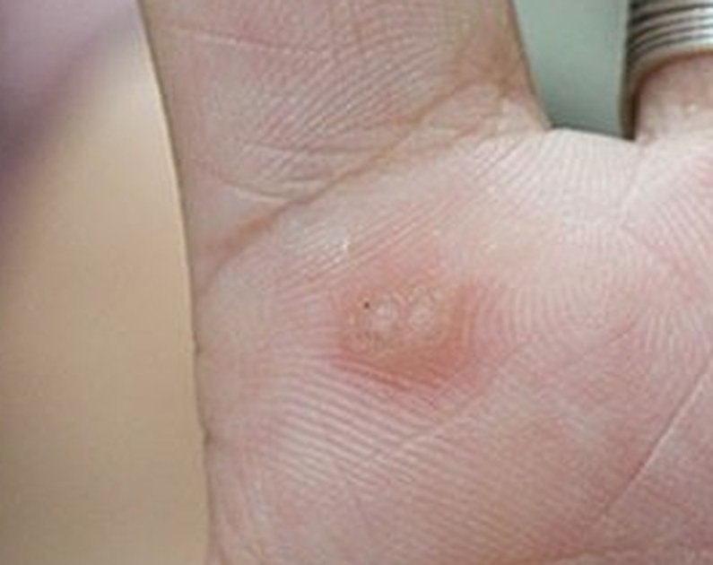 手のひらにできた尋常性疣贅（イボ）の例。表面がざらつき小さな黒い点が見える