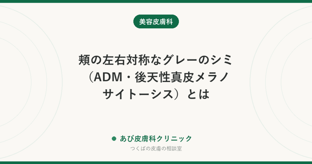 頬の左右対称なグレーのシミ（ADM・後天性真皮メラノサイトーシス）とは｜肝斑との見分けと治療の考え方