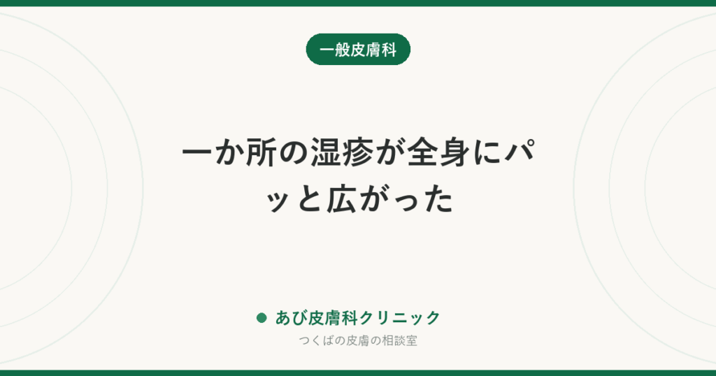 一か所の湿疹が全身にパッと広がった｜自家感作性皮膚炎の仕組みと、まず「もと」を治す理由