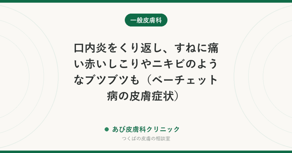 口内炎をくり返し、すねに痛い赤いしこりやニキビのようなブツブツも（ベーチェット病の皮膚症状）｜目の症状が大切な理由と受診先