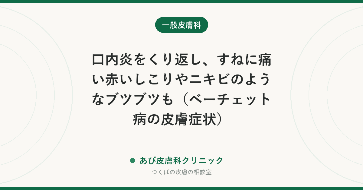 口内炎をくり返し、すねに痛い赤いしこりやニキビのようなブツブツも（ベーチェット病の皮膚症状）｜目の症状が大切な理由と受診先