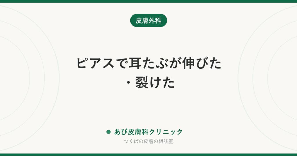 ピアスで耳たぶが伸びた・裂けた｜自然にくっつく？手術で治す方法と再発させないコツ