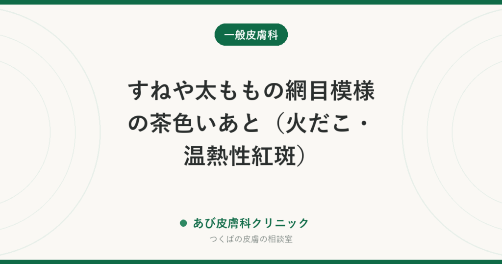 すねや太ももの網目模様の茶色いあと（火だこ・温熱性紅斑）｜こたつ・湯たんぽが原因。まず熱源を離すことから