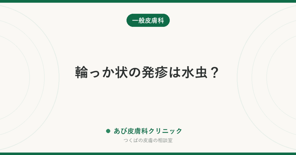 輪っか状の発疹は水虫？｜環状肉芽腫の特徴・白癬との見分け方と治療の考え方