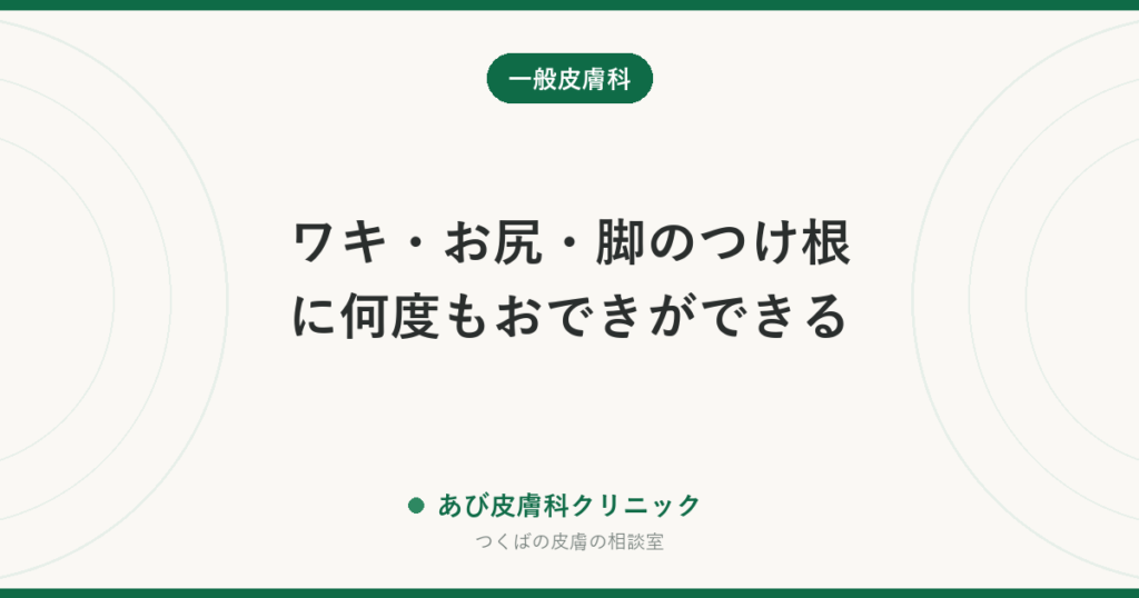ワキ・お尻・脚のつけ根に何度もおできができる｜化膿性汗腺炎という病気の可能性