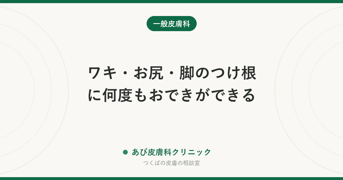ワキ・お尻・脚のつけ根に何度もおできができる｜化膿性汗腺炎という病気の可能性