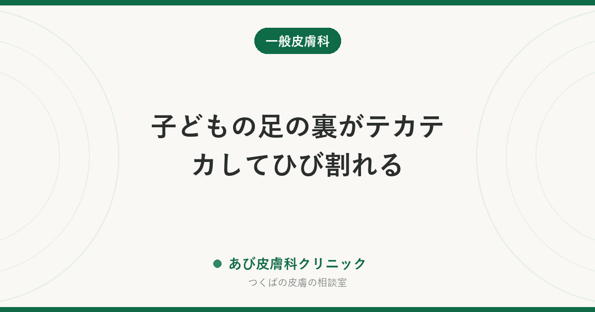 子どもの足の裏がテカテカしてひび割れる｜若年性足底皮膚炎とは？水虫との見分け方と靴下・靴の工夫