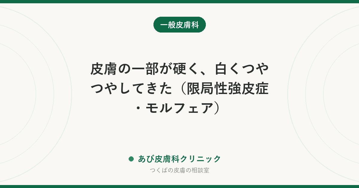 皮膚の一部が硬く、白くつやつやしてきた（限局性強皮症・モルフェア）｜全身の強皮症との違いと治療