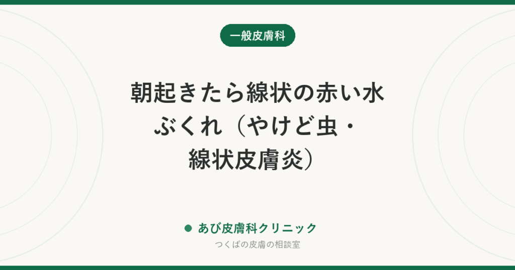 朝起きたら線状の赤い水ぶくれ（やけど虫・線状皮膚炎）｜アオバアリガタハネカクシの対処法と、つぶさずに払う理由