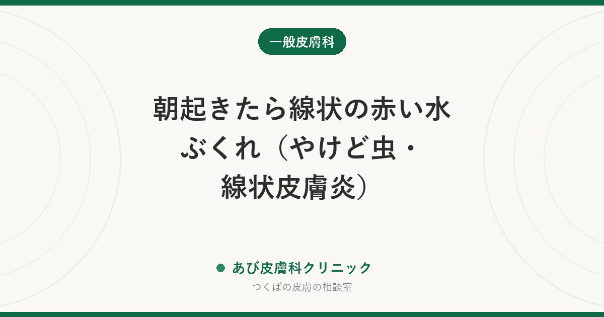 朝起きたら線状の赤い水ぶくれ（やけど虫・線状皮膚炎）｜アオバアリガタハネカクシの対処法と、つぶさずに払う理由