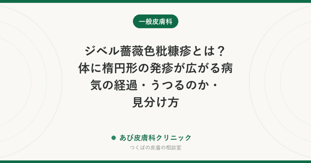 ジベル薔薇色粃糠疹とは？体に楕円形の発疹が広がる病気の経過・うつるのか・見分け方