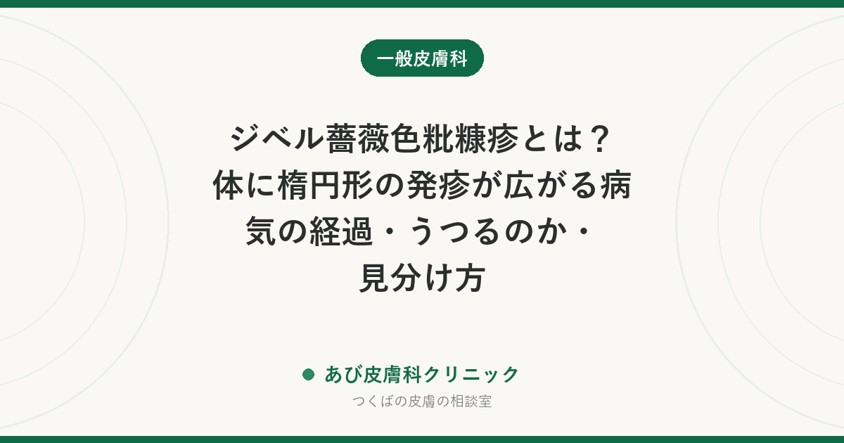 ジベル薔薇色粃糠疹とは？体に楕円形の発疹が広がる病気の経過・うつるのか・見分け方