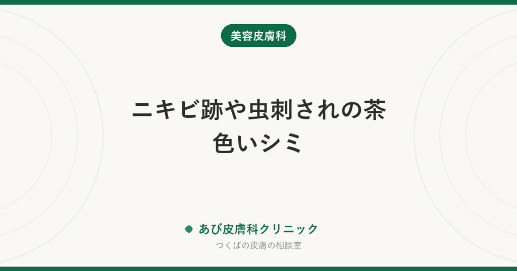 ニキビ跡や虫刺されの茶色いシミ｜炎症後色素沈着が消えるまでの期間と薄くする方法