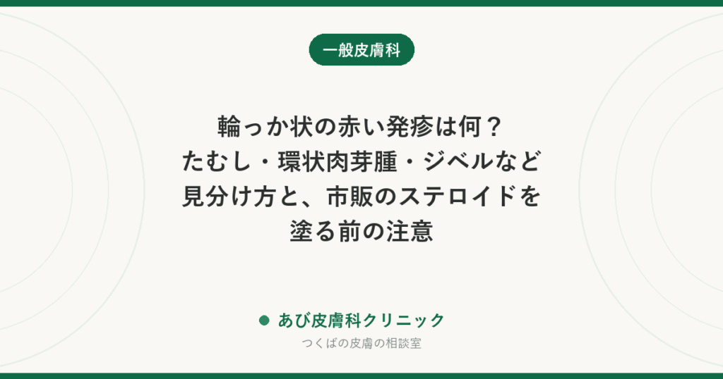 輪っか状の赤い発疹は何？たむし・環状肉芽腫・ジベルなど見分け方と、市販のステロイドを塗る前の注意