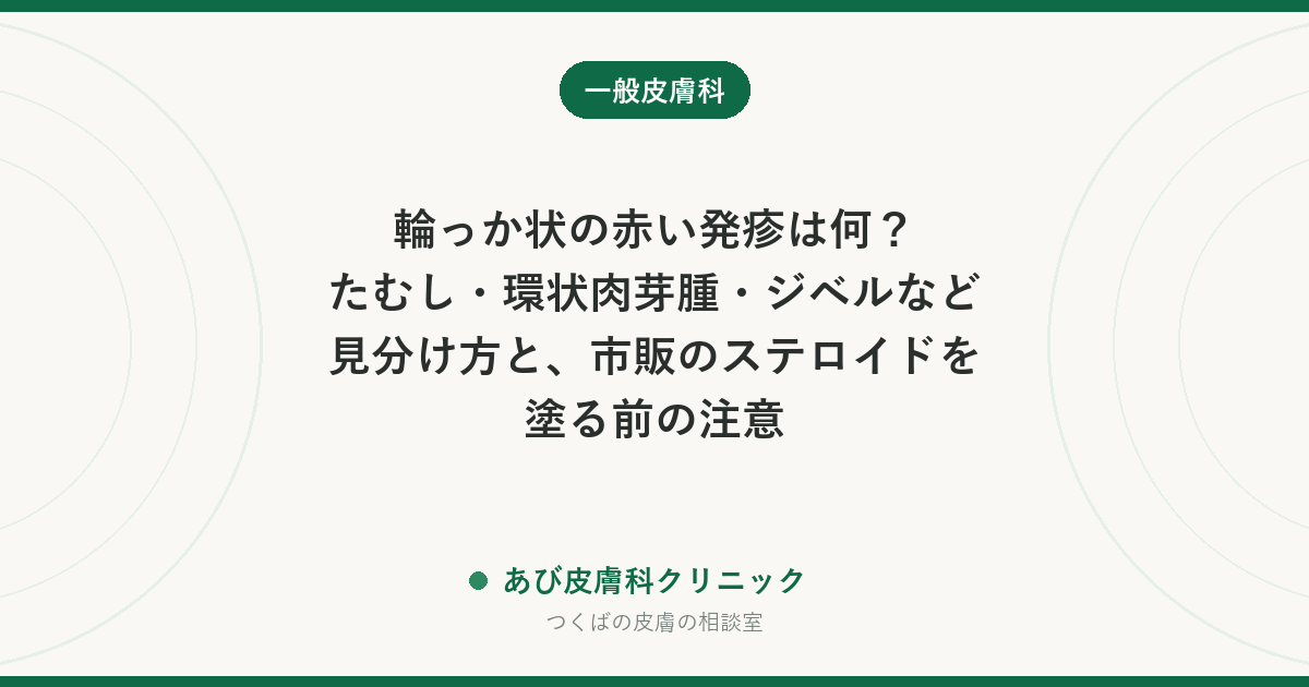 輪っか状の赤い発疹は何?たむし・環状肉芽腫・ジベルなど見分け方と、市販のステロイドを塗る前の注意