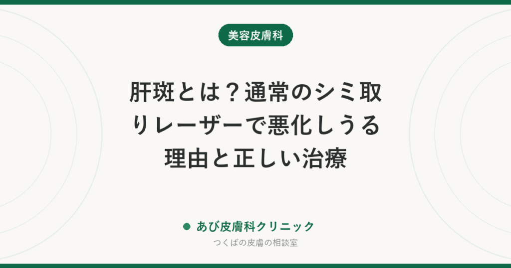 肝斑とは？通常のシミ取りレーザーで悪化しうる理由と正しい治療