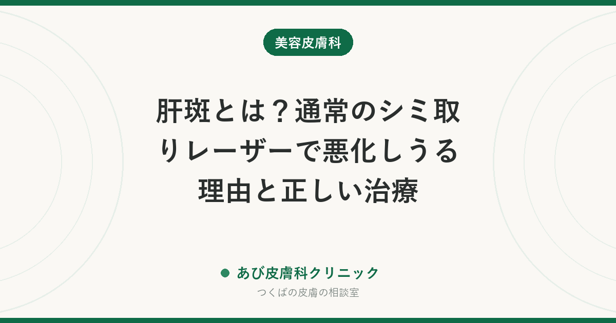 肝斑とは？通常のシミ取りレーザーで悪化しうる理由と正しい治療