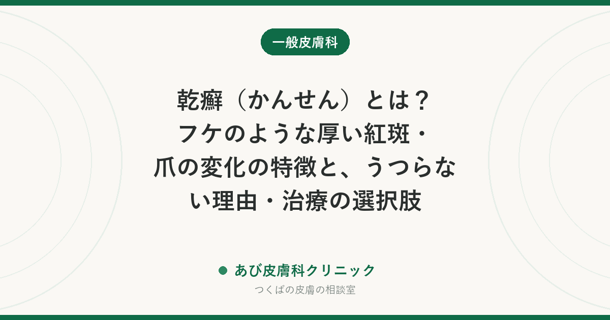 乾癬（かんせん）とは？フケのような厚い紅斑・爪の変化の特徴と、うつらない理由・治療の選択肢