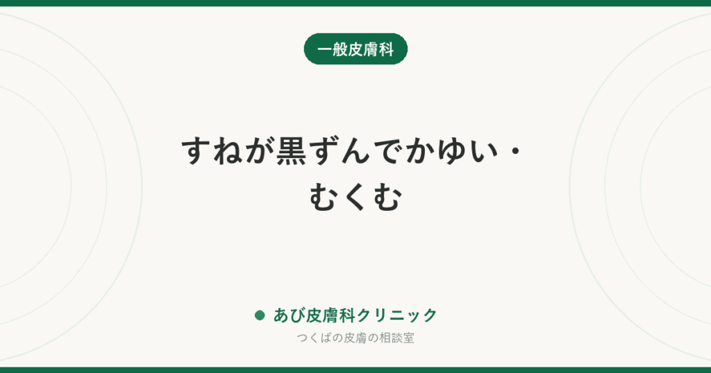 すねが黒ずんでかゆい・むくむ｜うっ滞性皮膚炎の原因と、湿疹との決定的な違い