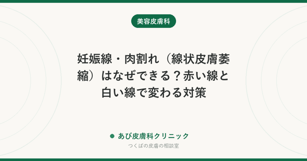 妊娠線・肉割れ（線状皮膚萎縮）はなぜできる？赤い線と白い線で変わる対策