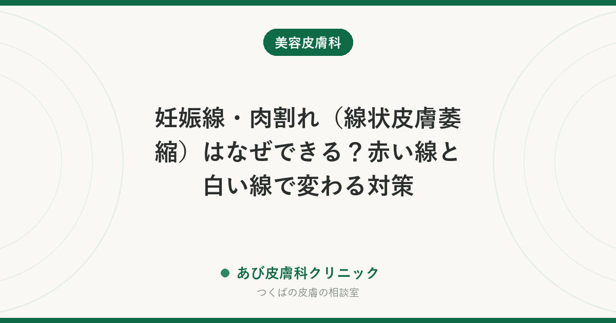 妊娠線・肉割れ（線状皮膚萎縮）はなぜできる？赤い線と白い線で変わる対策
