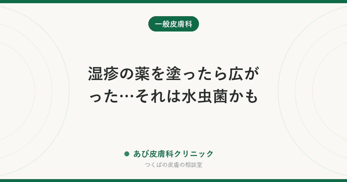 湿疹の薬を塗ったら広がった…それは水虫菌かも｜異型白癬とは？ステロイドで悪化する理由と正しい治し方