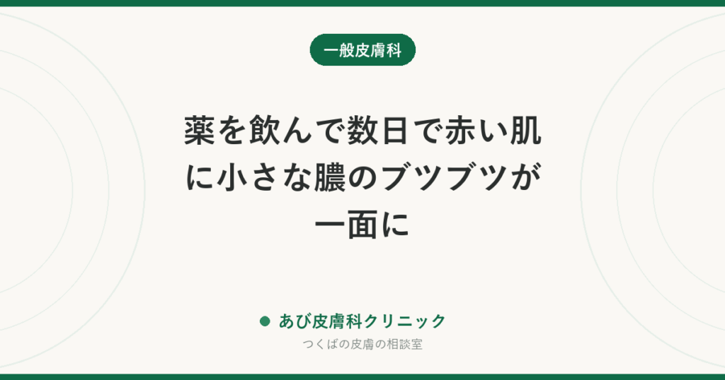 薬を飲んで数日で赤い肌に小さな膿のブツブツが一面に｜急性汎発性発疹性膿疱症（AGEP）とは？すぐ受診すべきサイン