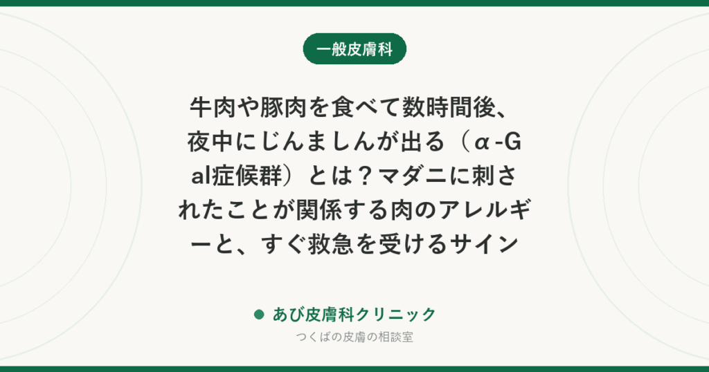 牛肉や豚肉を食べて数時間後、夜中にじんましんが出る（α-Gal症候群）とは？マダニに刺されたことが関係する肉のアレルギーと、すぐ救急を受けるサイン
