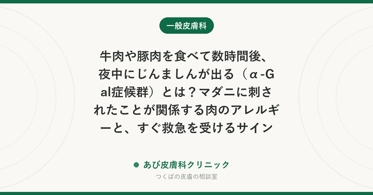 牛肉や豚肉を食べて数時間後、夜中にじんましんが出る（α-Gal症候群）とは？マダニに刺されたことが関係する肉のアレルギーと、すぐ救急を受けるサイン