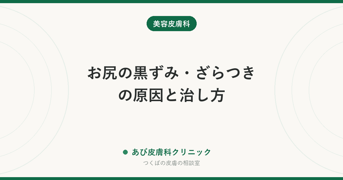 お尻の黒ずみ・ざらつきの原因と治し方｜座りっぱなし・摩擦・毛穴の炎症のあとを薄くするために今日からできること
