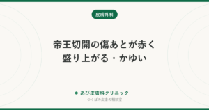 帝王切開の傷あとが赤く盛り上がる・かゆい｜肥厚性瘢痕・ケロイドの見分け方と、産後・授乳中にできるケア
