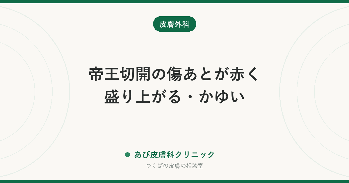 帝王切開の傷あとが赤く盛り上がる・かゆい｜肥厚性瘢痕・ケロイドの見分け方と、産後・授乳中にできるケア