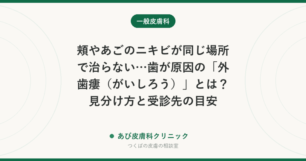 頬やあごのニキビが同じ場所で治らない…歯が原因の「外歯瘻（がいしろう）」とは？見分け方と受診先の目安