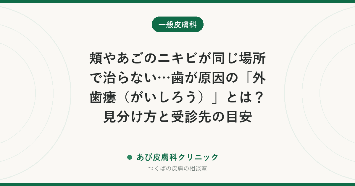 頬やあごのニキビが同じ場所で治らない…歯が原因の「外歯瘻（がいしろう）」とは？見分け方と受診先の目安
