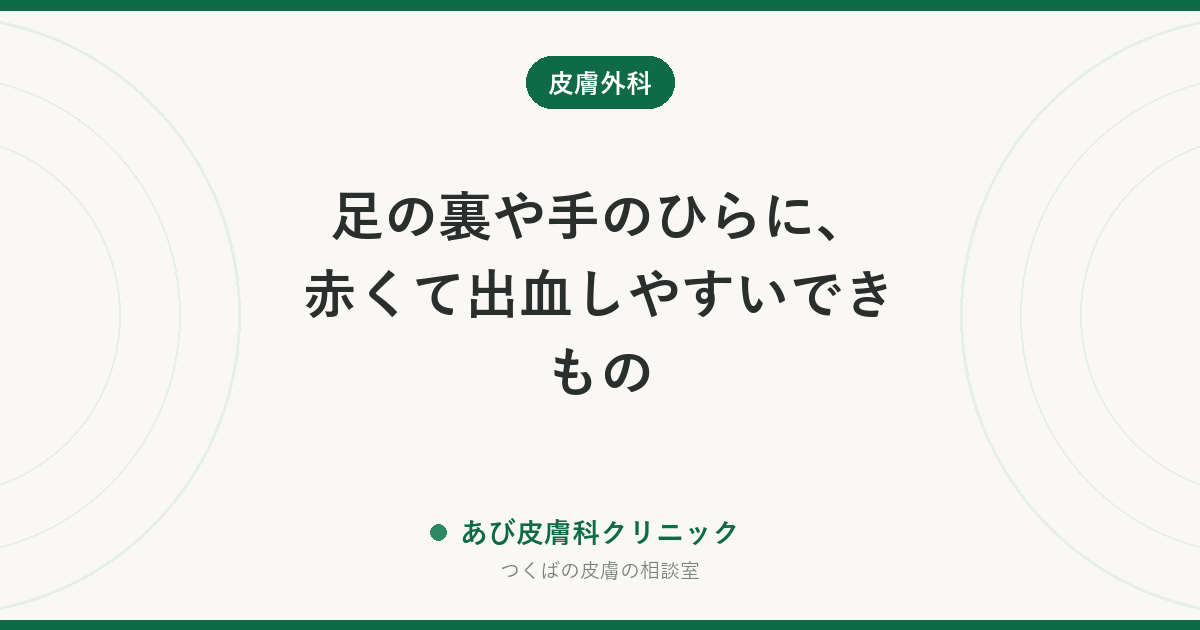 足の裏や手のひらに、赤くて出血しやすいできもの｜エクリン汗孔腫とは？血管腫・皮膚がんとの違いと治療