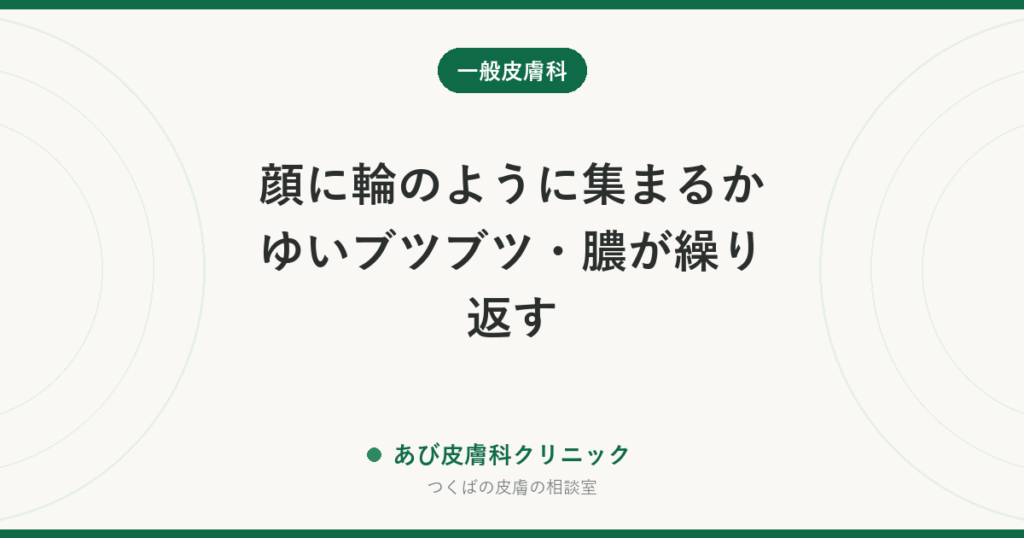 顔に輪のように集まるかゆいブツブツ・膿が繰り返す｜好酸球性膿疱性毛包炎とは？ニキビ・顔の水虫との違いと治療