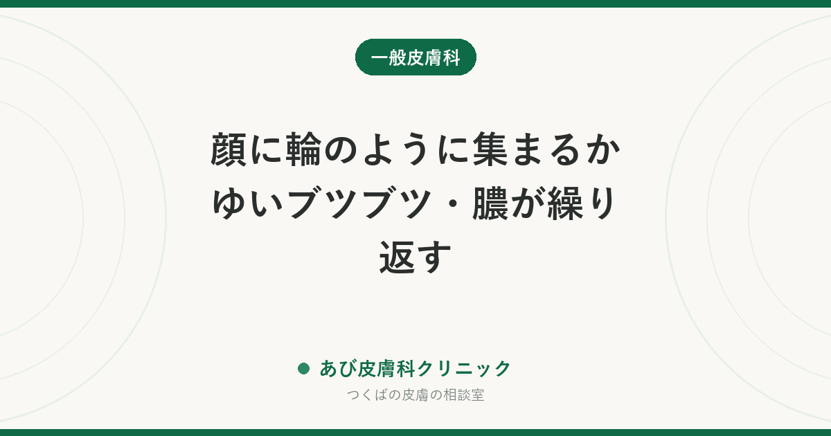 顔に輪のように集まるかゆいブツブツ・膿が繰り返す｜好酸球性膿疱性毛包炎とは？ニキビ・顔の水虫との違いと治療