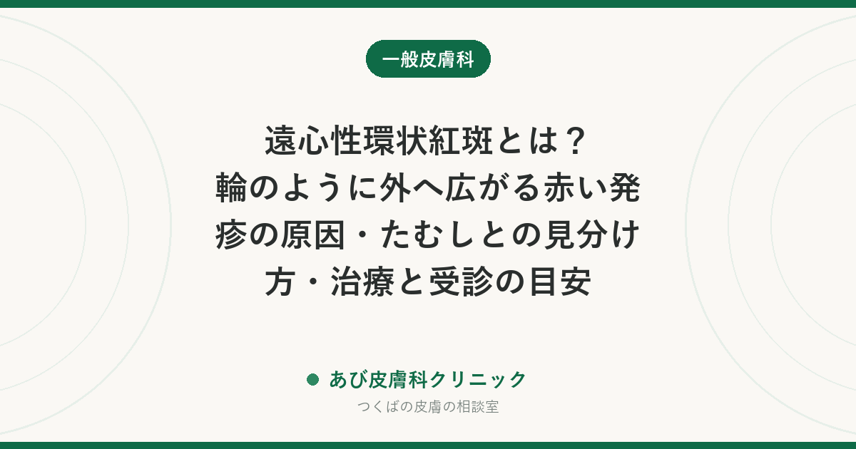 遠心性環状紅斑とは？輪のように外へ広がる赤い発疹の原因・たむしとの見分け方・治療と受診の目安
