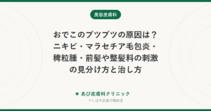 おでこのブツブツの原因は？ニキビ・マラセチア毛包炎・稗粒腫・前髪や整髪料の刺激の見分け方と治し方