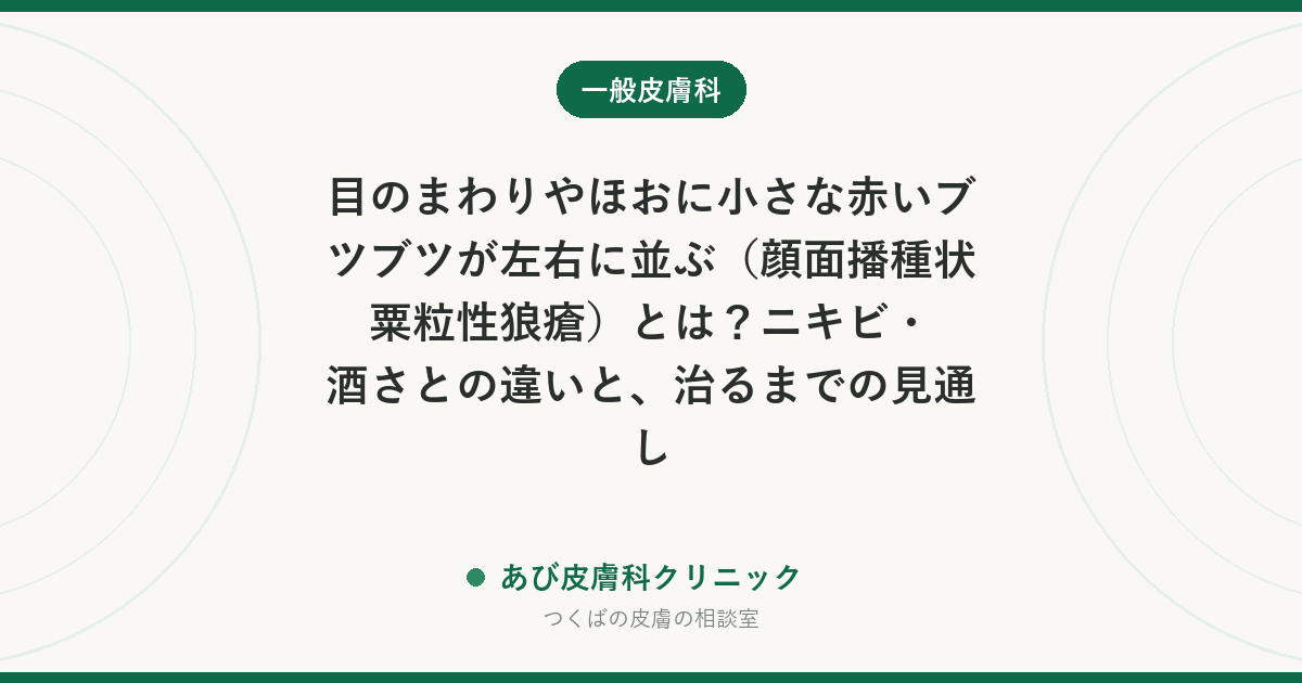 目のまわりやほおに小さな赤いブツブツが左右に並ぶ（顔面播種状粟粒性狼瘡）とは？ニキビ・酒さとの違いと、治るまでの見通し