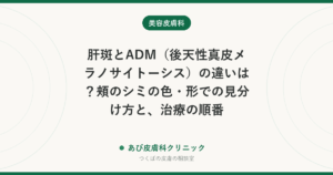 肝斑とADM（後天性真皮メラノサイトーシス）の違いは？頬のシミの色・形での見分け方と、治療の順番