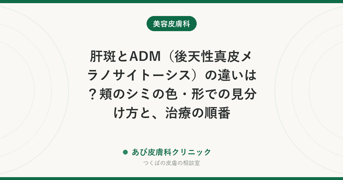 肝斑とADM（後天性真皮メラノサイトーシス）の違いは？頬のシミの色・形での見分け方と、治療の順番