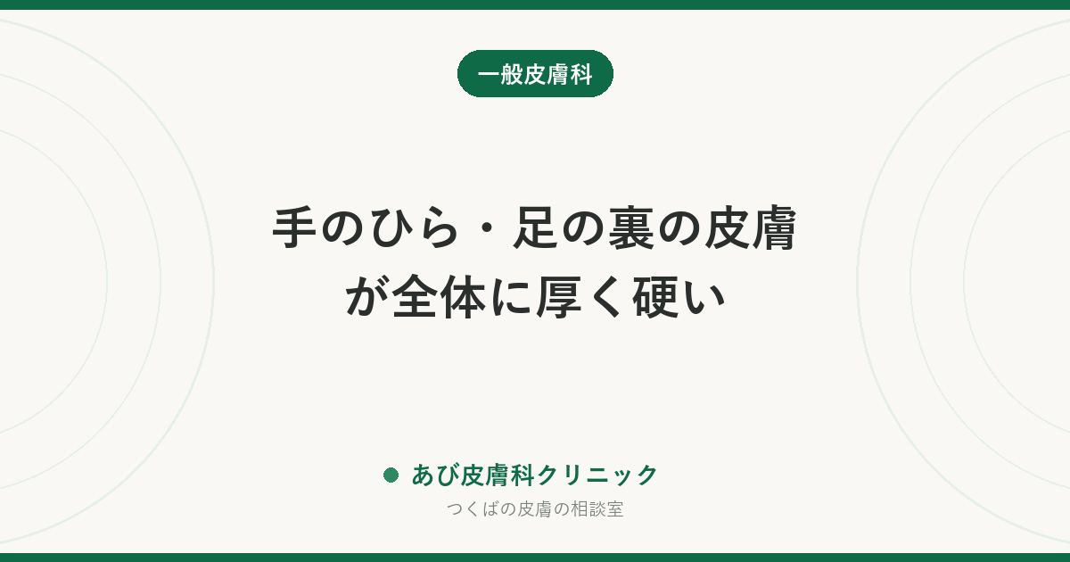 手のひら・足の裏の皮膚が全体に厚く硬い｜掌蹠角化症（しょうせきかくかしょう）とは？タコ・水虫との違いとケアの方法
