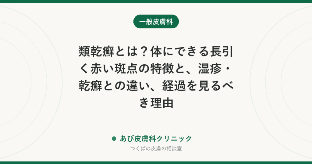 類乾癬とは？体にできる長引く赤い斑点の特徴と、湿疹・乾癬との違い、経過を見るべき理由
