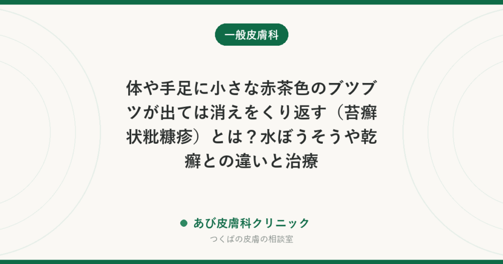 体や手足に小さな赤茶色のブツブツが出ては消えをくり返す（苔癬状粃糠疹）とは？水ぼうそうや乾癬との違いと治療