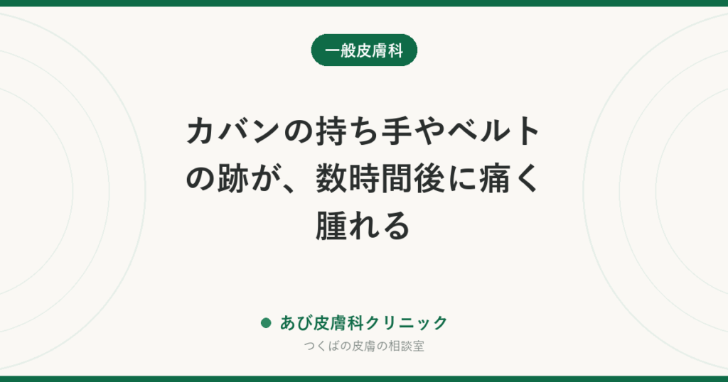 カバンの持ち手やベルトの跡が、数時間後に痛く腫れる｜遅延性圧蕁麻疹とは？皮膚描記症との違いと対策