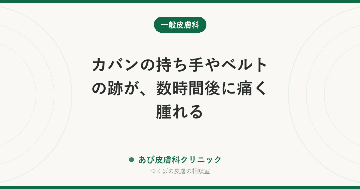カバンの持ち手やベルトの跡が、数時間後に痛く腫れる｜遅延性圧蕁麻疹とは？皮膚描記症との違いと対策