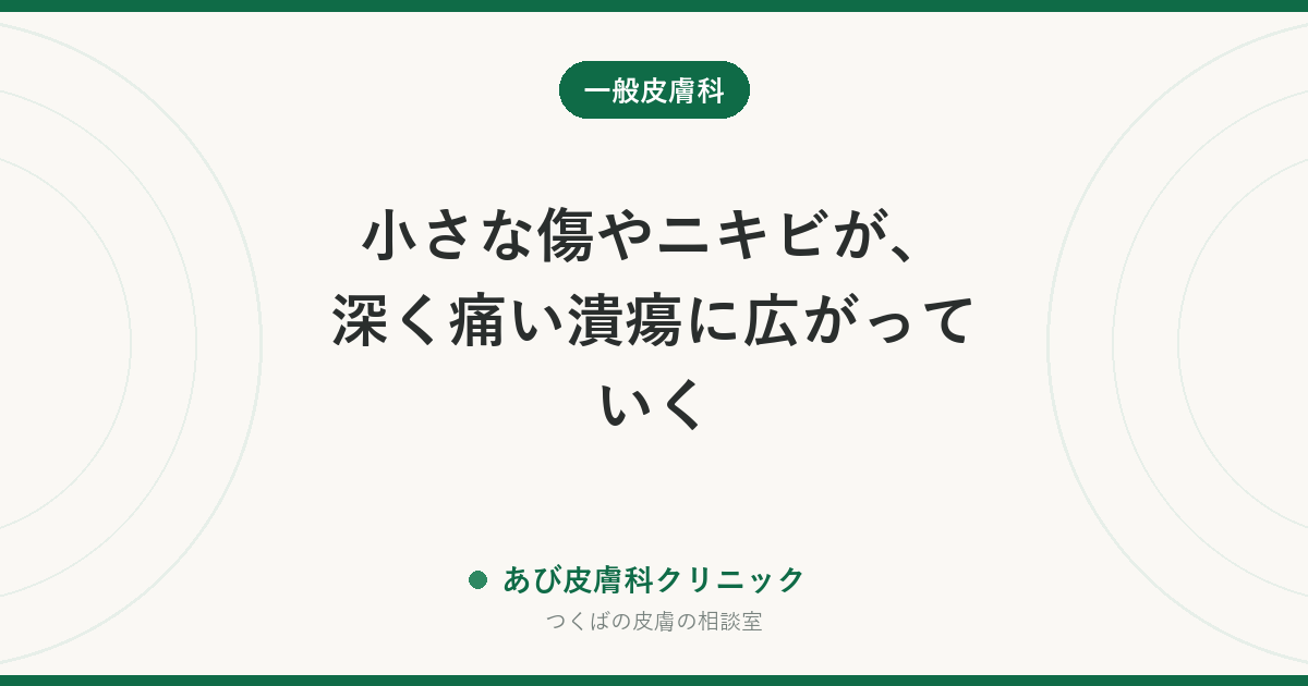 小さな傷やニキビが、深く痛い潰瘍に広がっていく｜壊疽性膿皮症とは？抗菌薬が効かない理由と受診の目安
