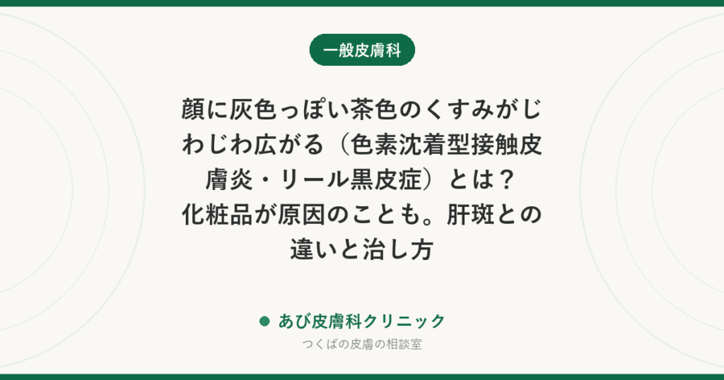 顔に灰色っぽい茶色のくすみがじわじわ広がる（色素沈着型接触皮膚炎・リール黒皮症）とは？化粧品が原因のことも。肝斑との違いと治し方